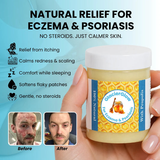 GlacierGlow - Repair Balm For Eczema & Psoriasis